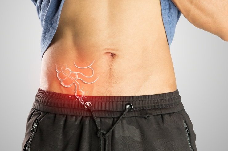 Appendicitis Surgery